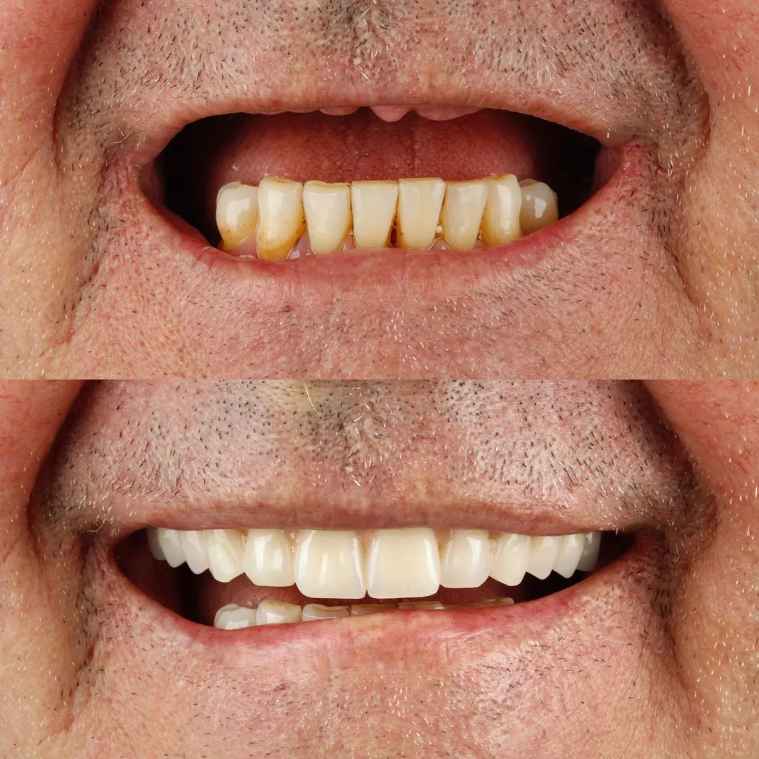 Dental Implant
