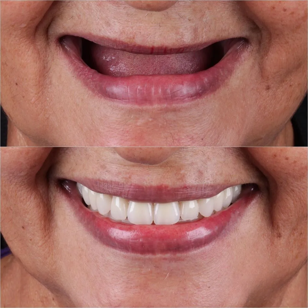 Dental Implant