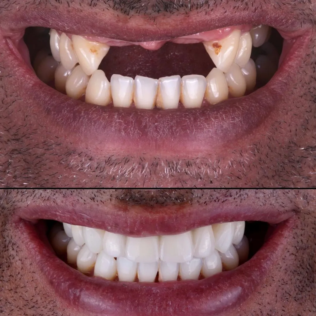 Dental Implant