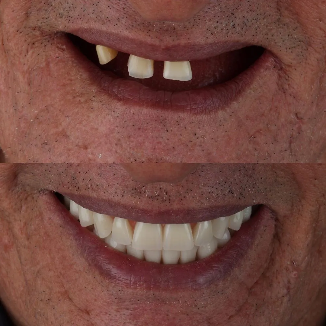 Dental Implant