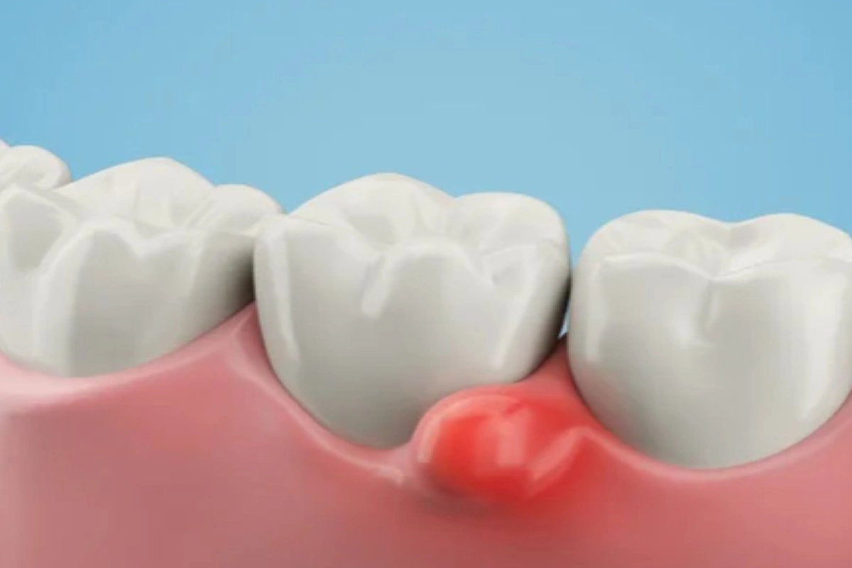 What is a Dental Cyst?
