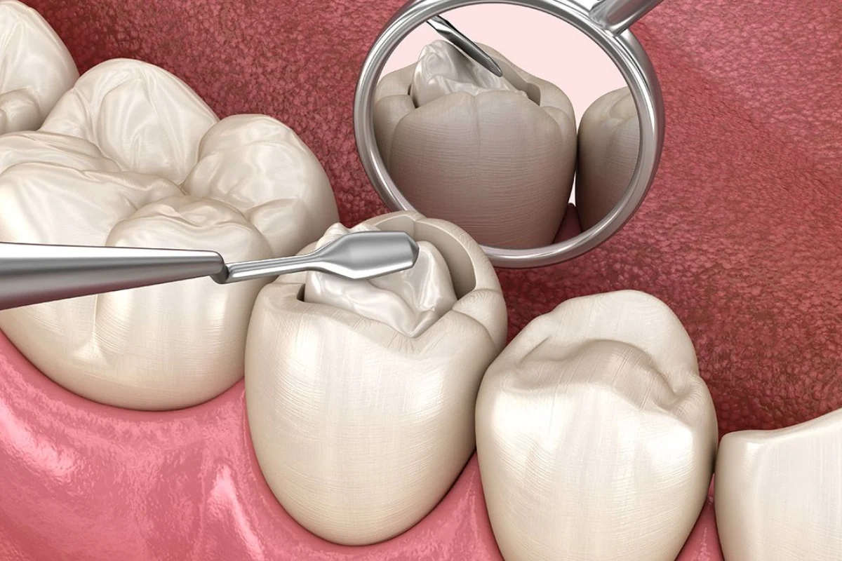 When Should a Dental Filling Be Replaced?