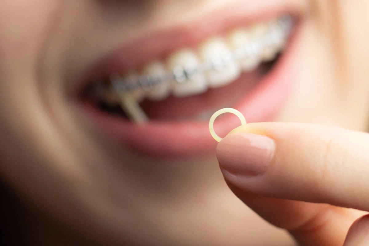 What is an Orthodontic Elastic?