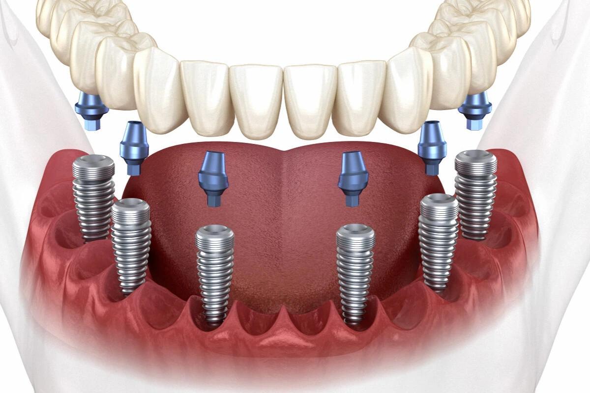 Full Mouth Dental Implants