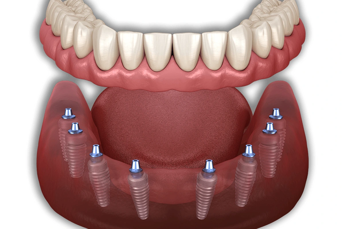 All-on-8 Dental Implants