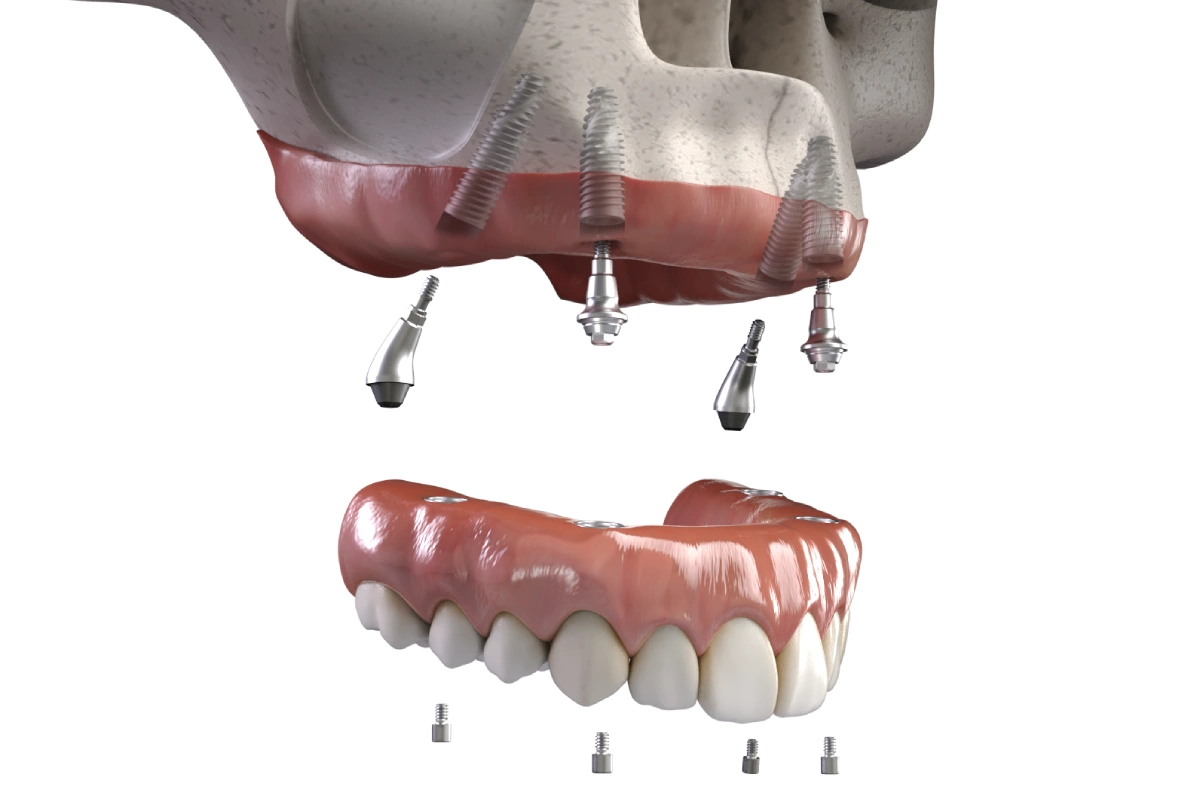 All-on-X Dental Implants