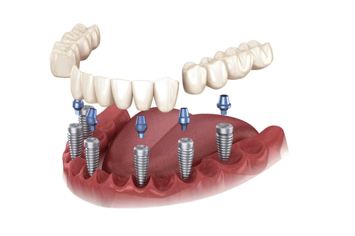 3-on-6 Dental Implants