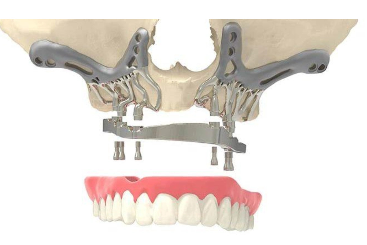 Subperiosteal Implants