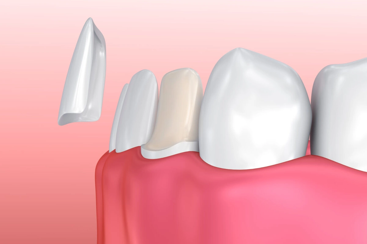 Porcelain veneers