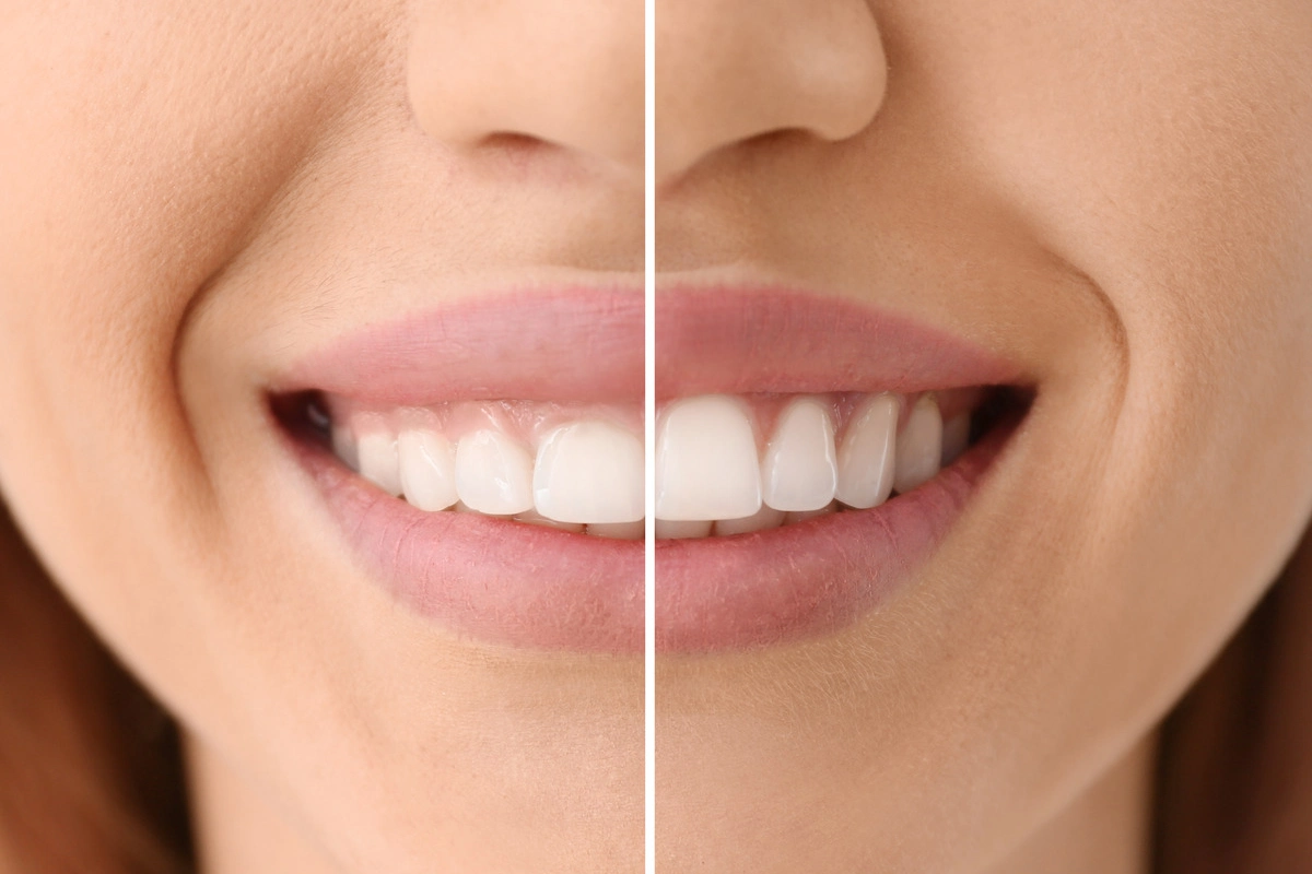 Gum Contouring