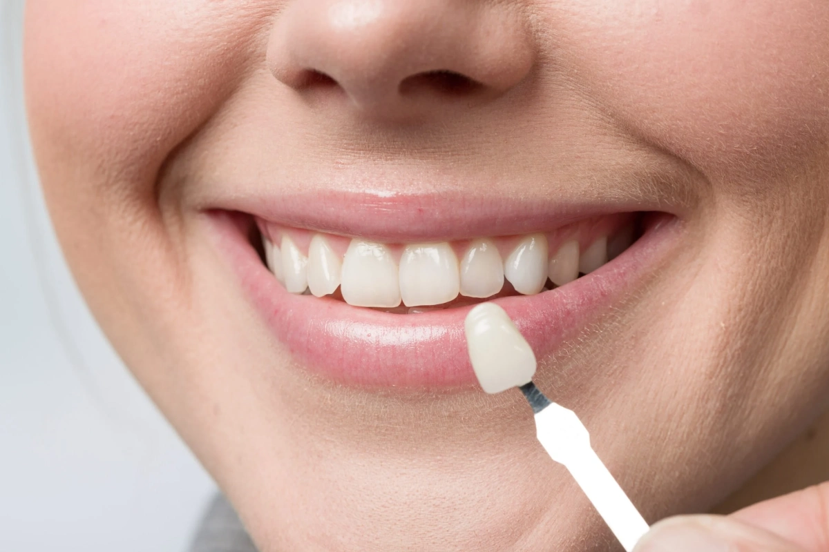Dental Veneers