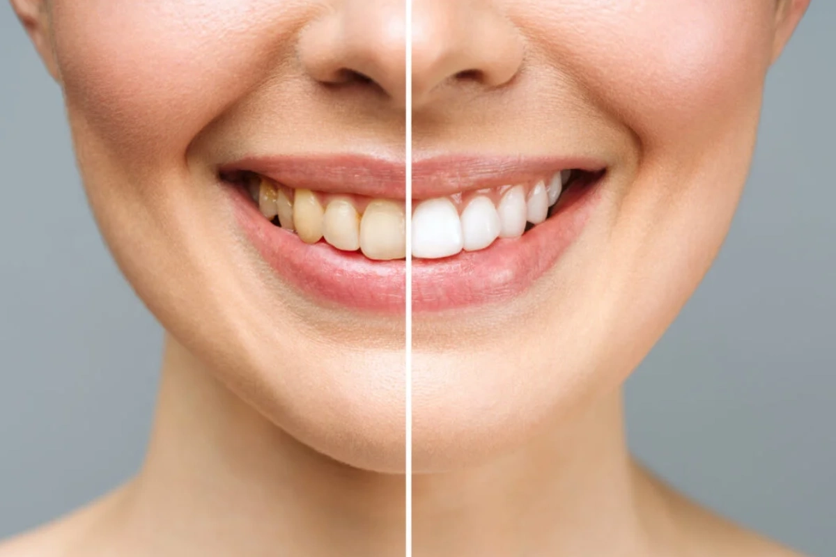 Teeth Whitening
