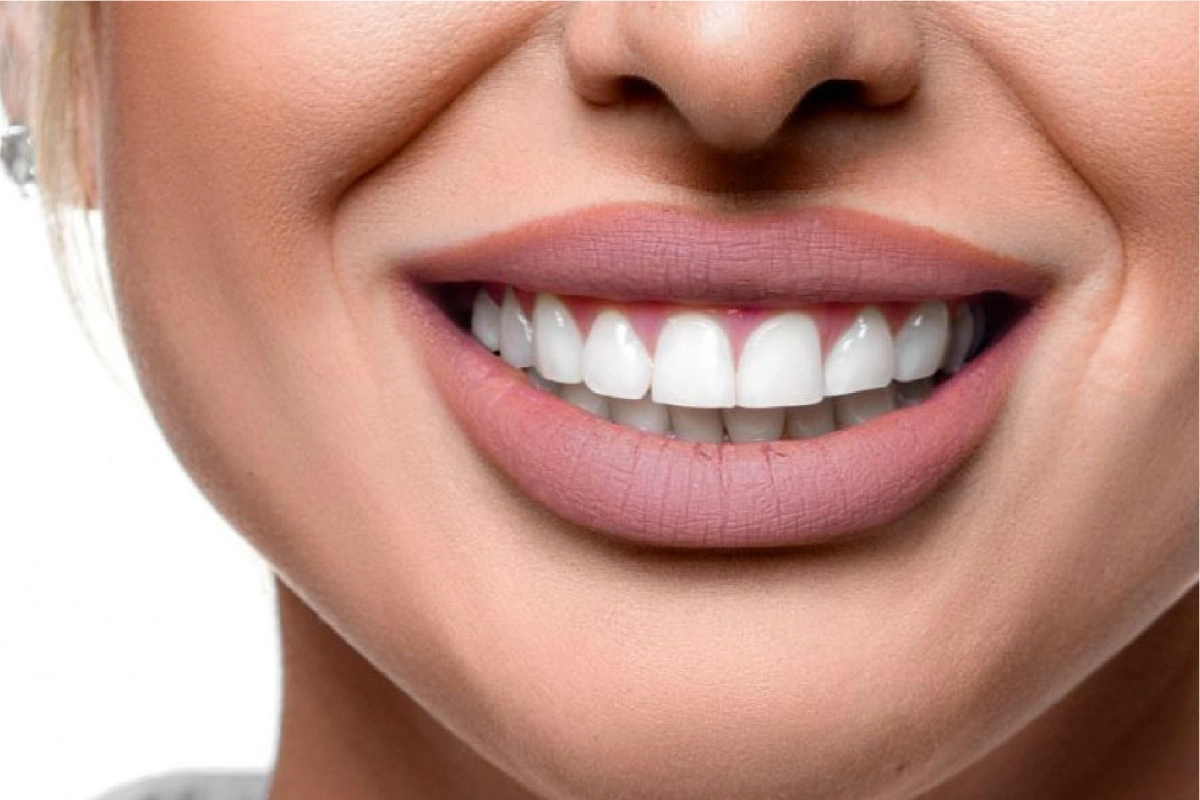 Hollywood Smile