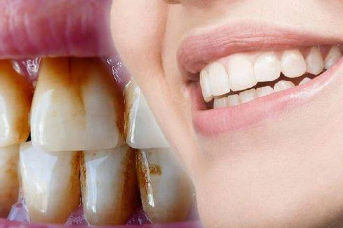 Brown stains on teeth
