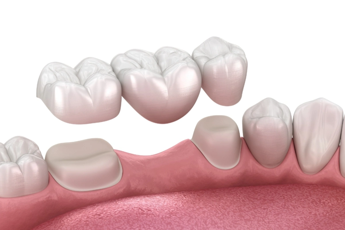Dental Bridge
