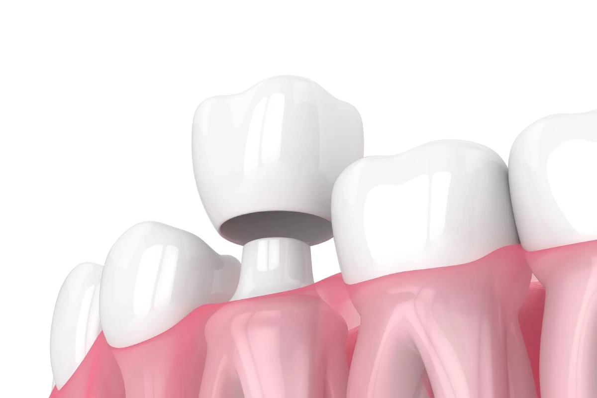 Dental Crowns