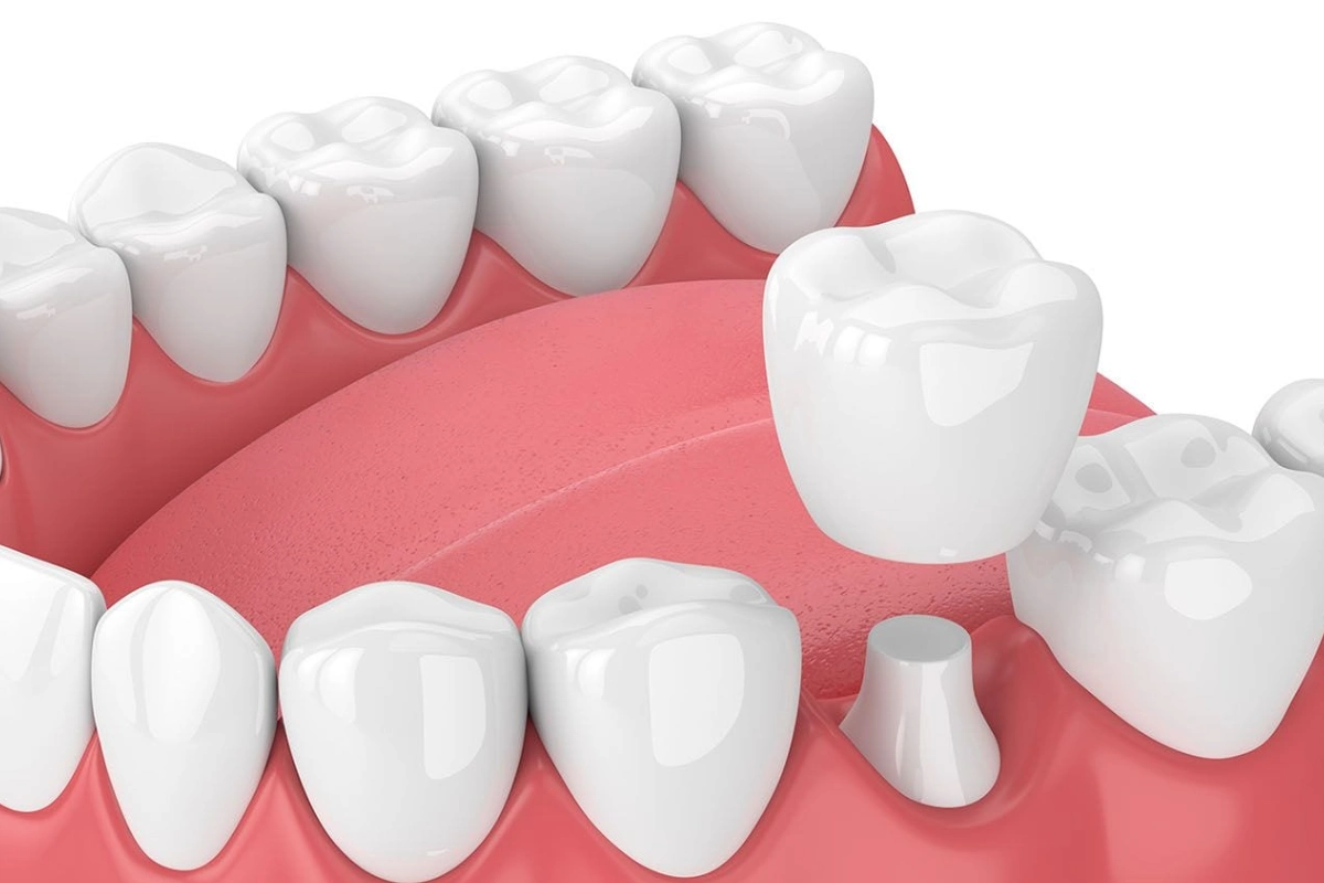 Dental Crowns Zirconia