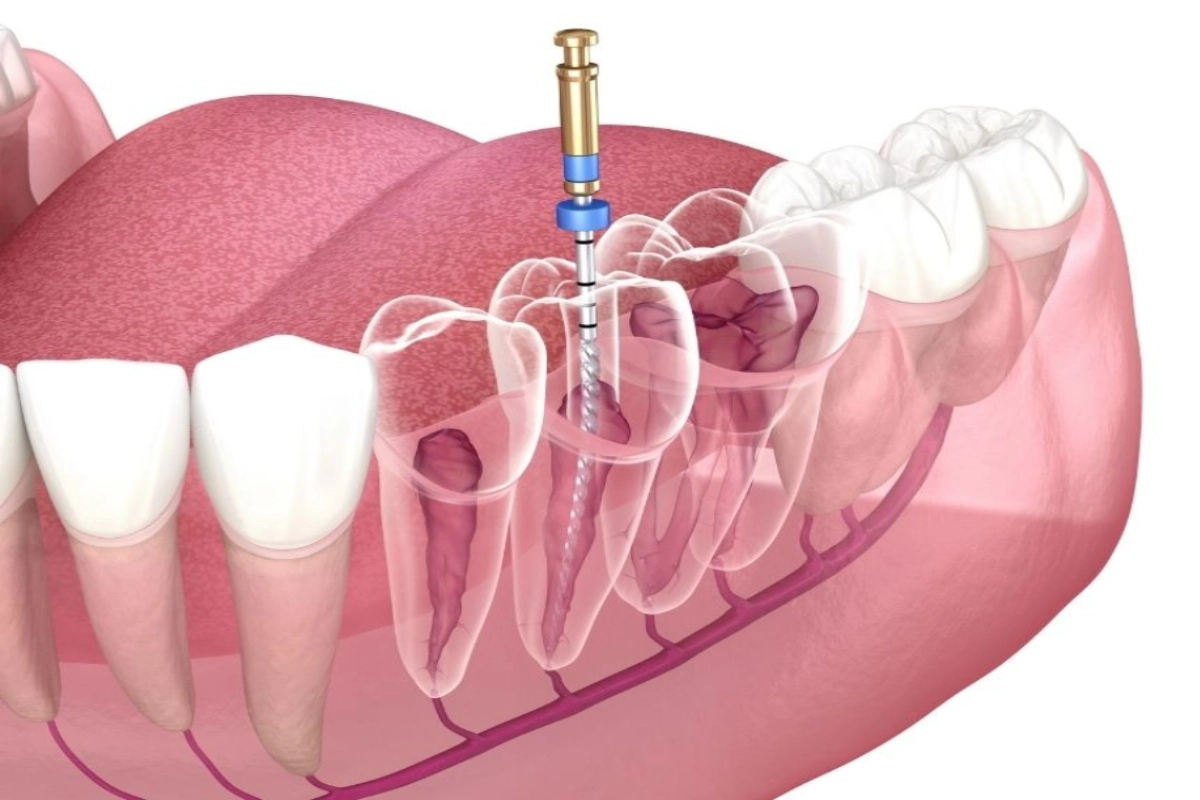 Root Canal Therapy