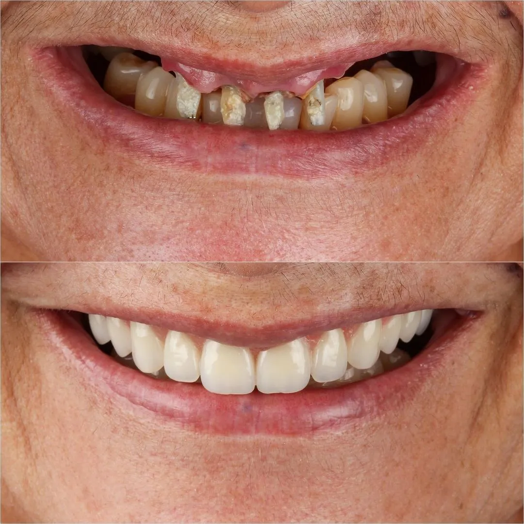 Before/After