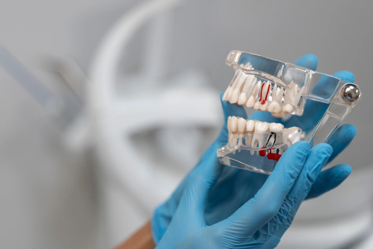 Full-Arch Dental Implants (All-on-X)