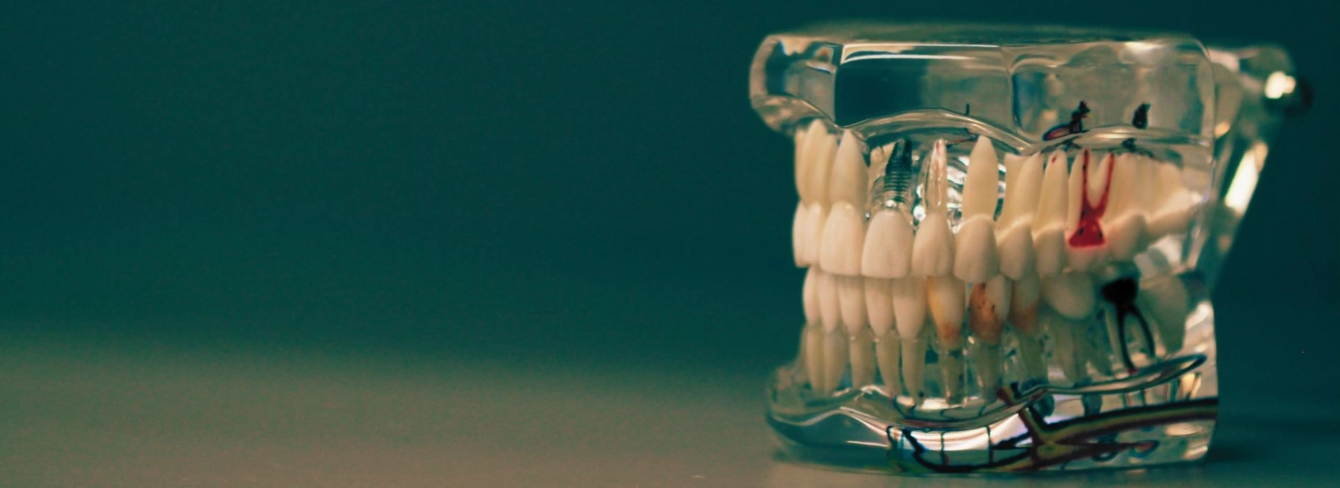All-on-4, All-on-6 & All-on-X Dental Implants — A Confident Smile Again